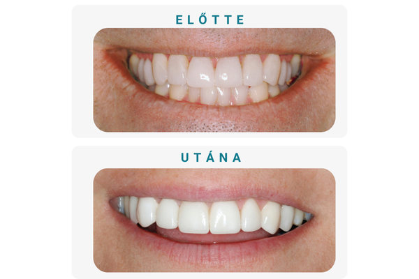 előtte (1)