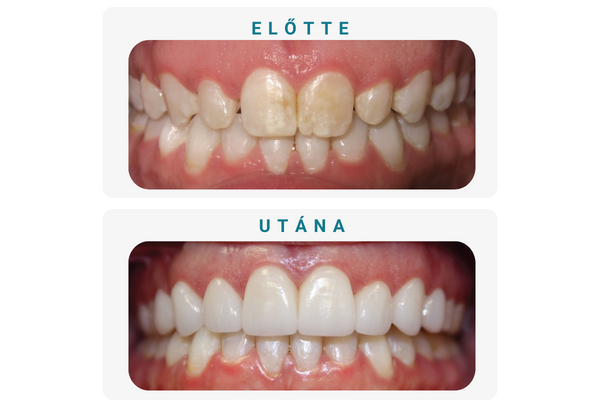 előtte (2)