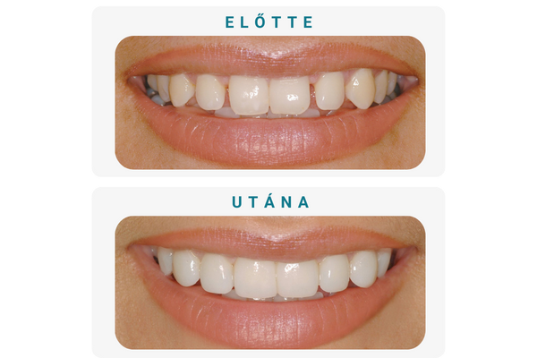 előtte (5)
